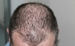 Ursachen von Haarausfall