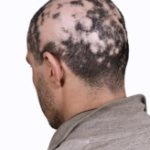 Kreisrunder Haarausfall (Alopecia areata)