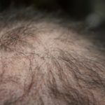 Vernarbender Haarausfall (narbige Alopezie)