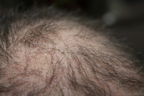 Vernarbender Haarausfall (narbige Alopezie)